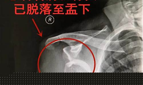 打篮球肩膀疼原因分析-打篮球肩膀酸